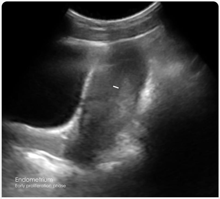 Uterine lining ultrasound